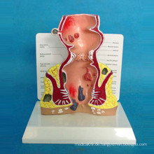 Human Rectum Medizinisches Anatomisches Demonstrationsmodell für die Lehre (R100209)